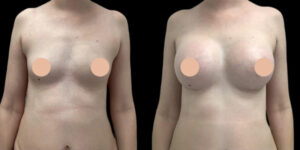 How Safe Is Breast Augmentation in Dubai? Expert Insight