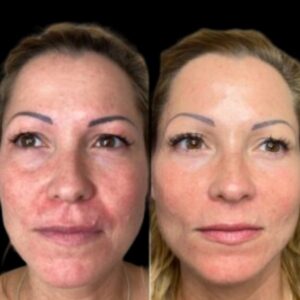 Why the Best Plastic Surgeons in Dubai Recommend Profhilo for Youthful Skin