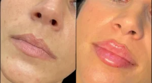 Fillers in Dubai