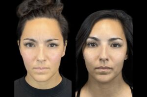 Top Areas Treated with Botox by the Best Plastic Surgeons in Dubai