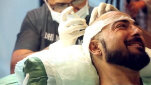 Hair Transplant in Dubai for Bald Spots