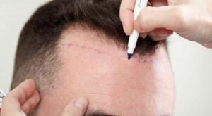 Hair transplant in Islamabad