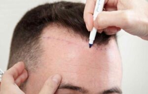 Hair transplant in Islamabad