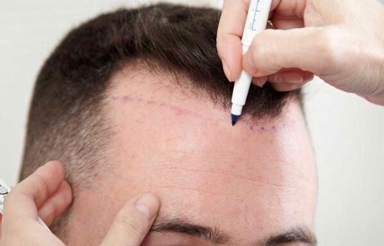 Hair transplant in Islamabad