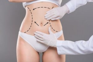 What Is The Recovery Time After Liposuction In Dubai?
