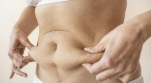 Best Liposuction Surgeon in Dubai