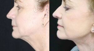 Double Chin Liposuction in Dubai
