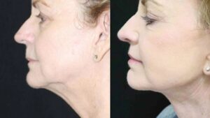 Double Chin Liposuction in Dubai
