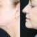 Double Chin Liposuction in Dubai