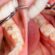 Tooth Filling Cost in Dubai