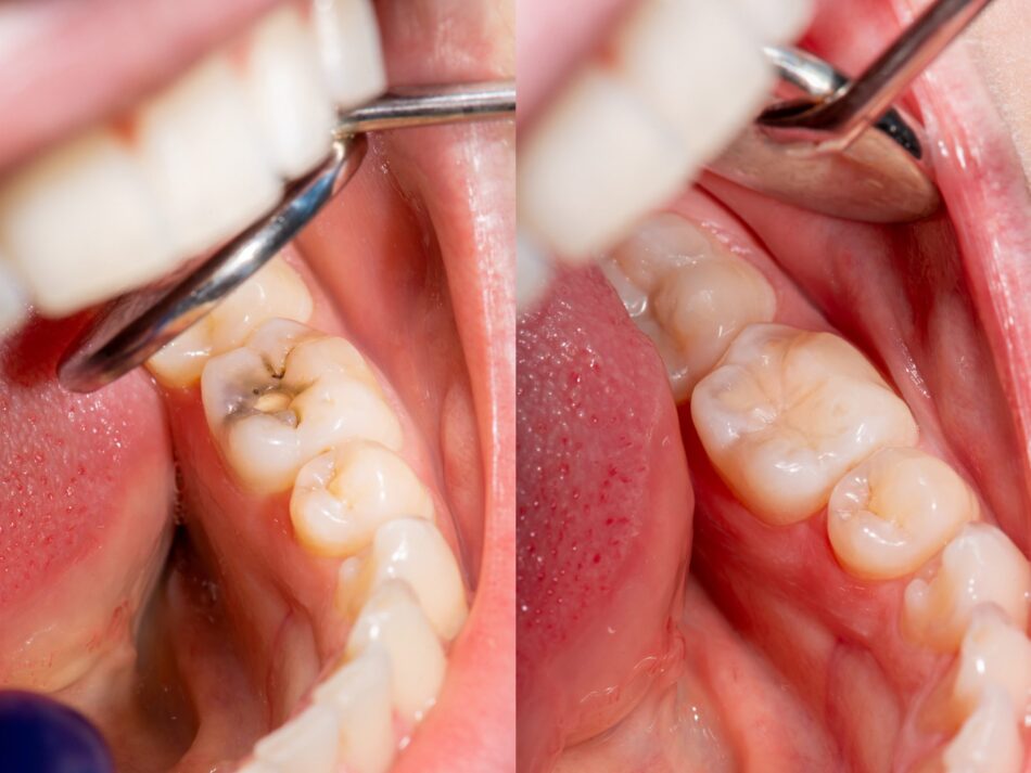 Tooth Filling Cost in Dubai