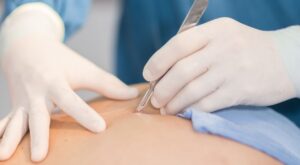 Skin Wart Removal Cost in Dubai