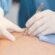 Skin Wart Removal Cost in Dubai