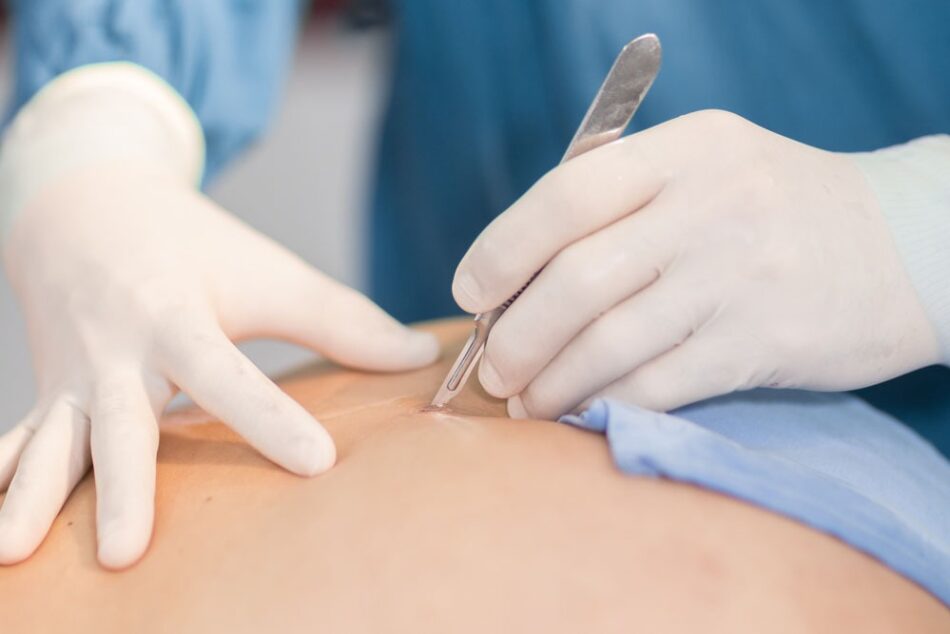 Skin Wart Removal Cost in Dubai