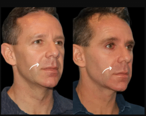 Ethical Aesthetics: Best Plastic Surgeon in Dubai on Honest Sculptra Fillers Practices