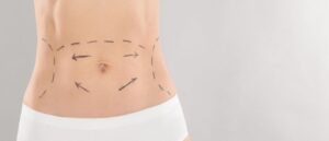 How Old Should I Be To Get A Tummy Tuck In Dubai?