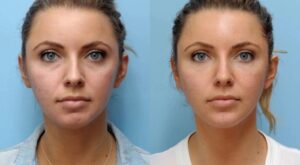 What Makes Thread Lift Treatment in Dubai a Popular Non-Surgical Facelift Option