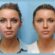 What Makes Thread Lift Treatment in Dubai a Popular Non-Surgical Facelift Option
