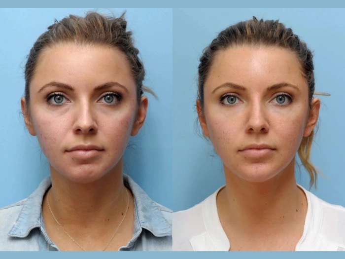 What Makes Thread Lift Treatment in Dubai a Popular Non-Surgical Facelift Option