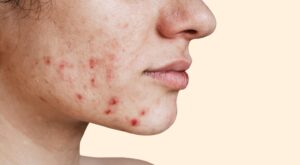 Acne Treatment Dubai