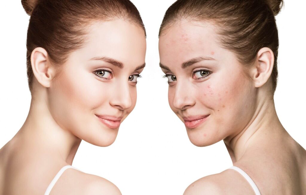 Cold Peel in Dubai