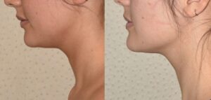 Can Double Chin Liposuction be combined with other treatments?