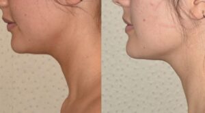 Double Chin Liposuction in Dubai