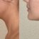 Double Chin Liposuction in Dubai