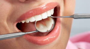 Tooth Filling Cost in Dubai