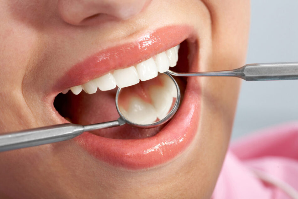 Tooth Filling Cost in Dubai