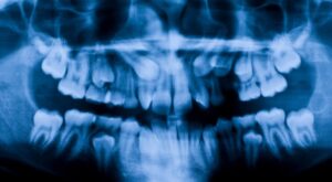 Panoramic Dental X-Ray Cost in Dubai
