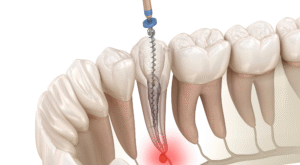Root Canal Treatment in Dubai