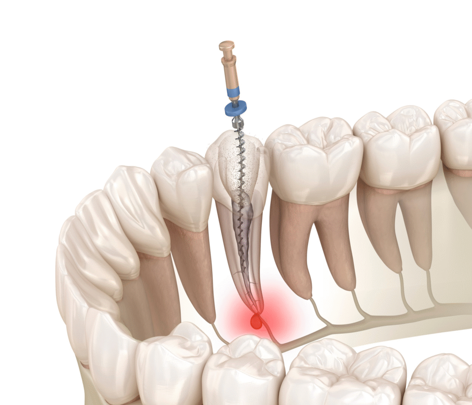 Root Canal Treatment in Dubai