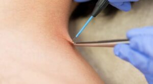 Skin Wart Removal Cost in Dubai