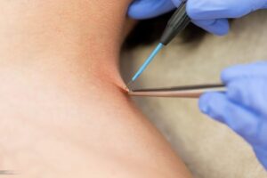 Skin Wart Removal Cost in Dubai