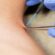 Skin Wart Removal Cost in Dubai