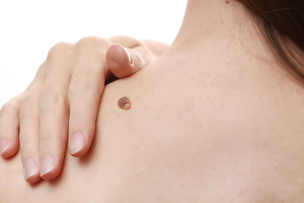 Skin Wart Removal Cost in Dubai