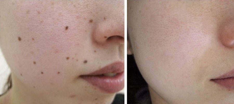 Skin Wart Removal Cost in Dubai