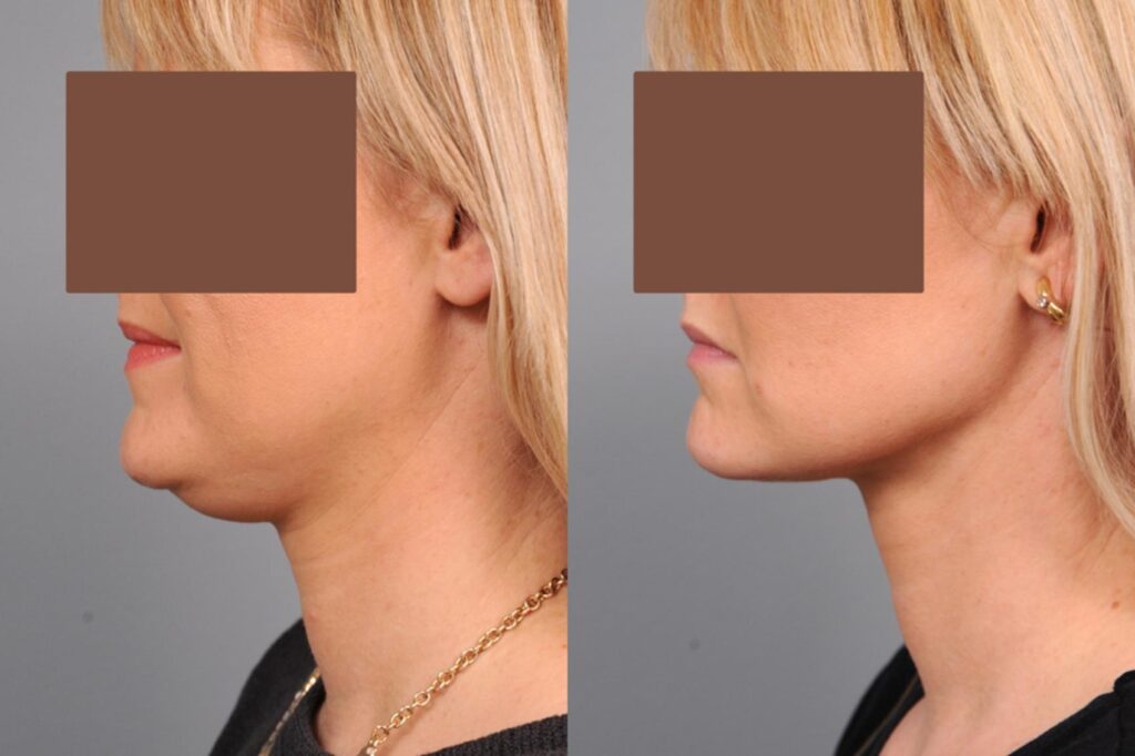 Double Chin Liposuction in Dubai