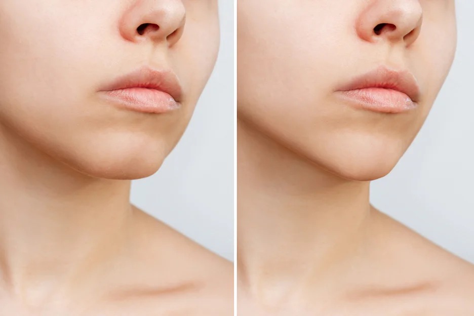Double Chin Liposuction in Dubai