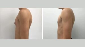 Gynecomastia surgery