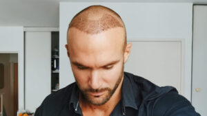 Hair Transplant for Thinning Hair: Safe and Proven Results