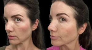 dark circles treatment in dubai