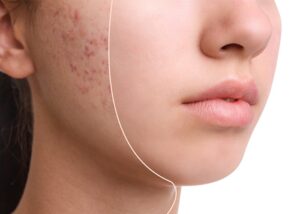 Acne Scar Treatment: Restore Smooth & Confident Skin