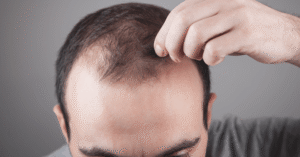 Hair Specialist Doctor Answers Common Hair Loss Questions