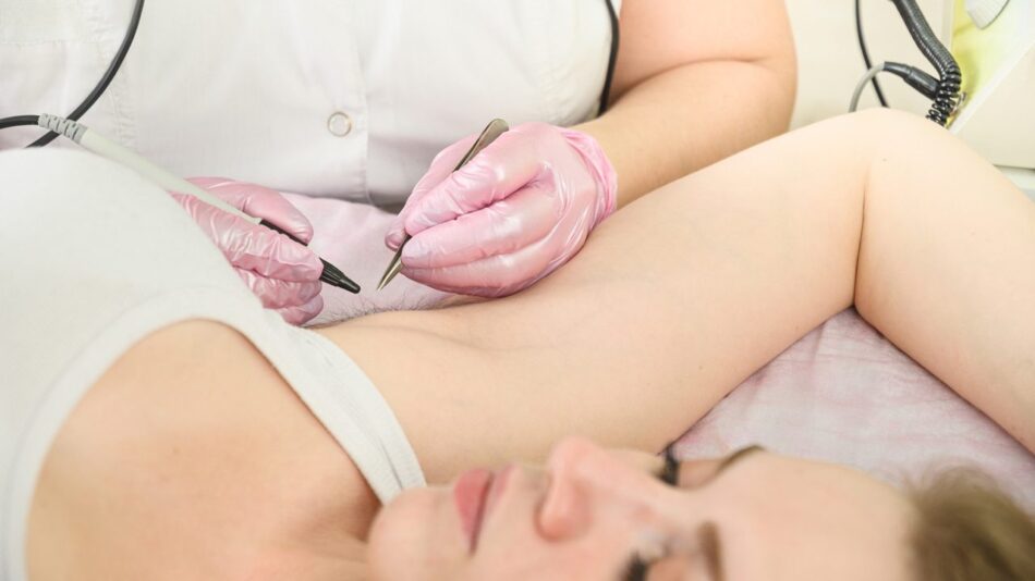 Electrolysis Laser Hair Removal in Dubai
