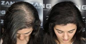 Can I Continue My Gym Routine After Hair Loss Treatment in Dubai?