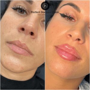 Is Dermal Filler Treatment Right for You? A Consultation Guide at the Best Aesthetic Clinic in Dubai