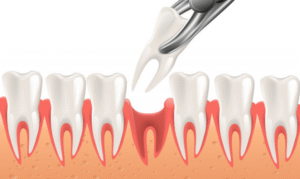 Do Clinics in Dubai Offer Affordable Sedation Options for Tooth Extractions?