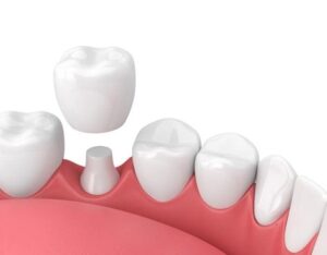 Do Temporary Crowns Offer Enough Protection Before the Final One?